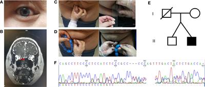 Kallmann Syndrome Due to Heterozygous Mutation in SOX10 Coexisting With Waardenburg Syndrome Type II: Case Report and Review of Literature